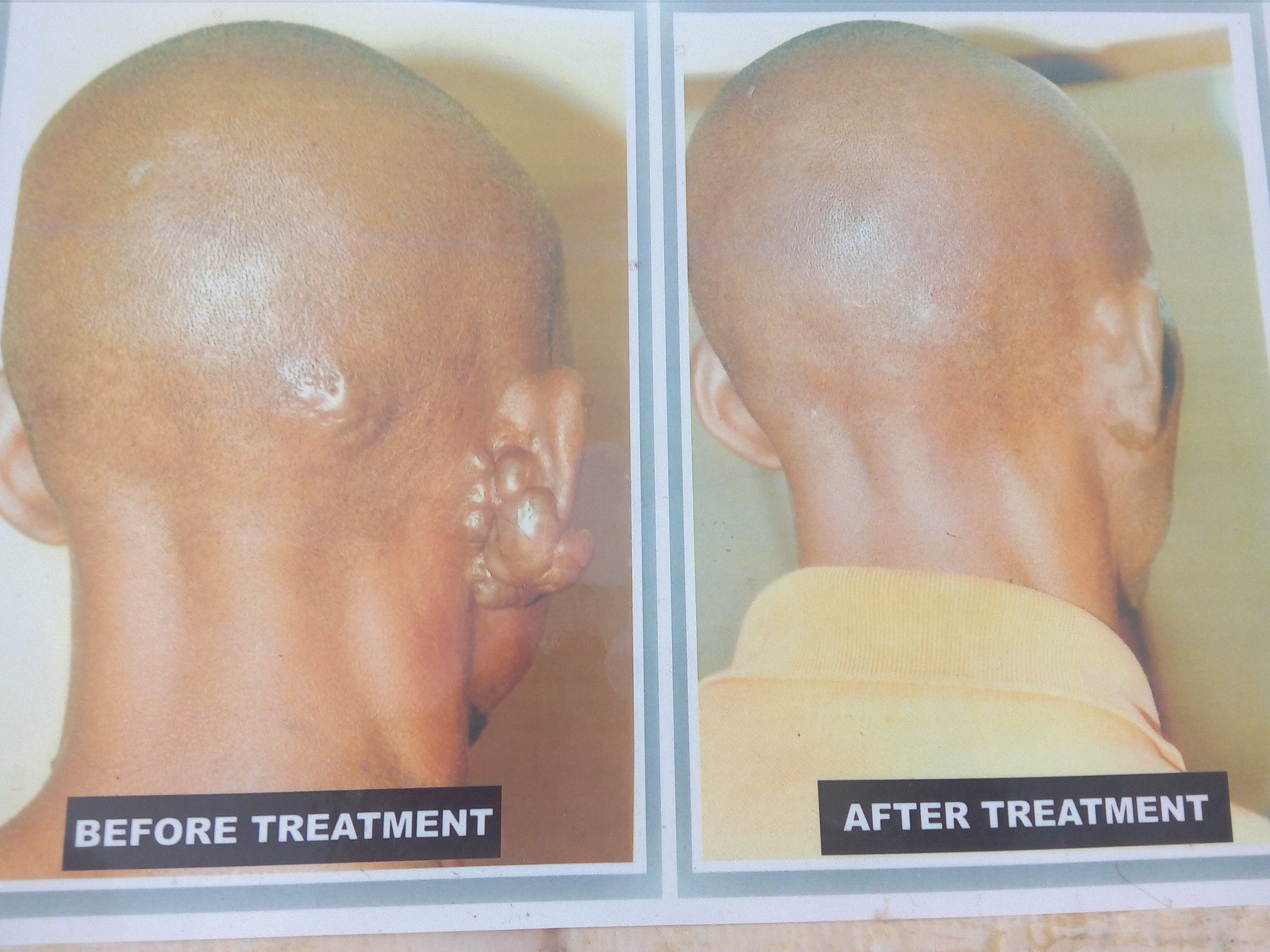 Dr. Orlando establishes Bumbs and keloid treatment Centre in Jos