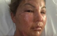 Photos: Horror! Woman Suffers Serious Burns As Her Hand Sanitiser Explodes While She Was Lighting A Candle